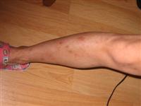 kathy_leg_after